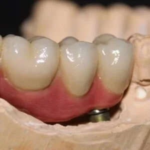 Implant CMB Bridge