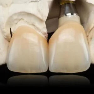 Implant E-Max Crown