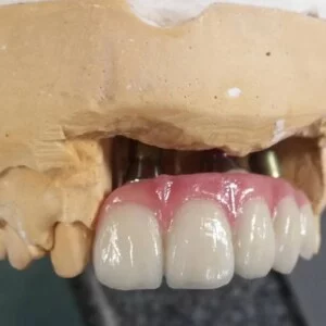 Implant Zirconia Bridge