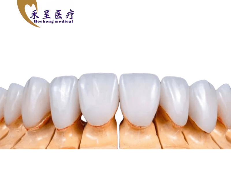 Porcelain Veneer Wholesale