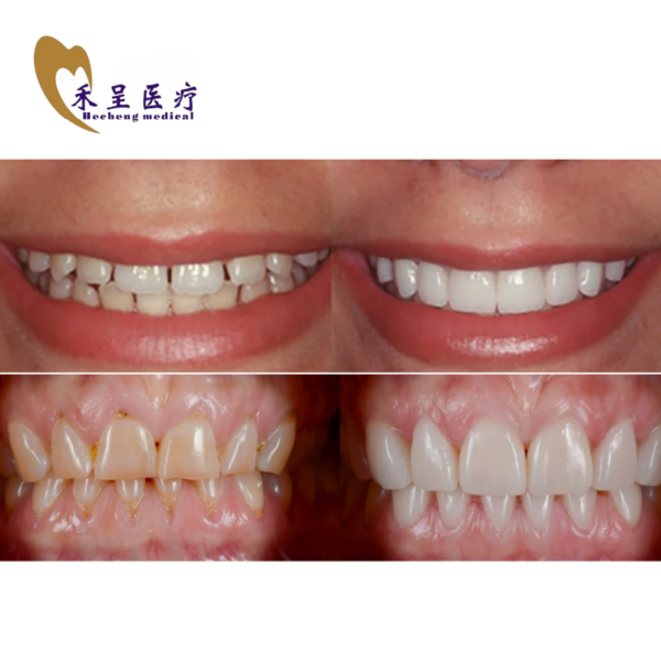 Veneer on Teeth Wholesale