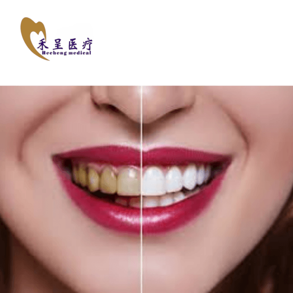 Whiten Veneer Teeth Lab