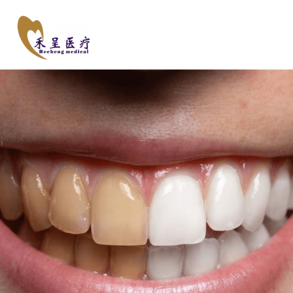 Whiten Veneer Teeth Manufacturer