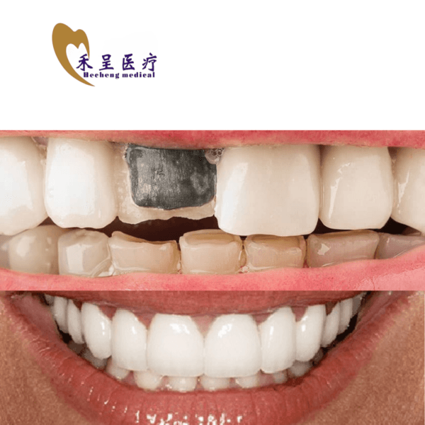 PFM Crown Dental