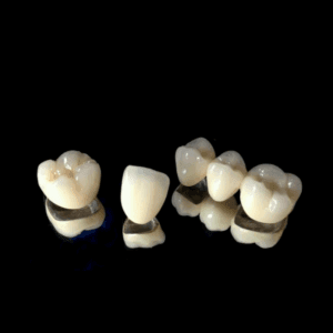 PFM Crown dental