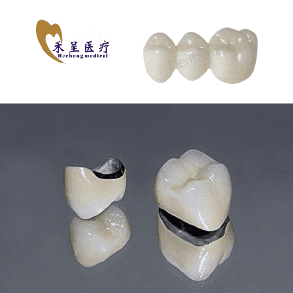 PFM Crowns Dental