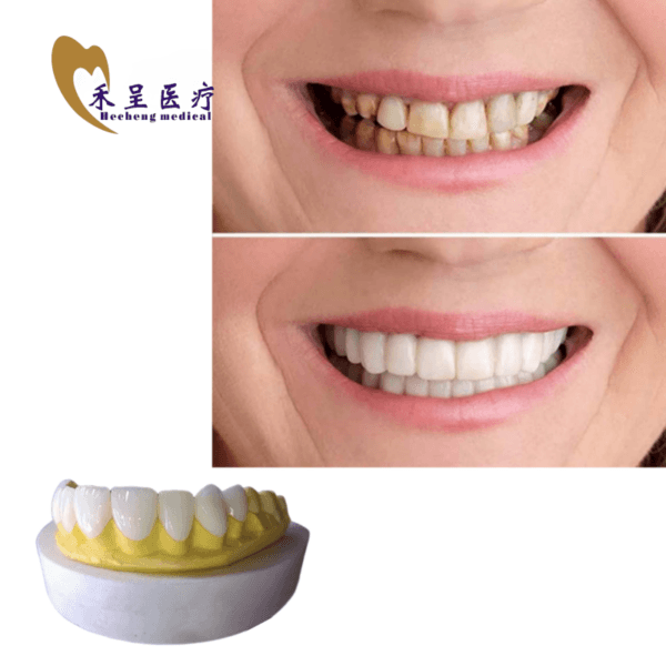 Veneer Teeth High Quality 