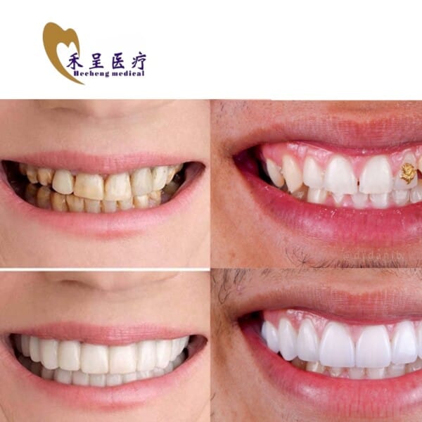 Veneer Tooth Dental