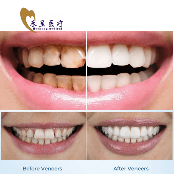 Veneer for Teeth Dental