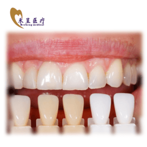 Veneer on Teeth Dental
