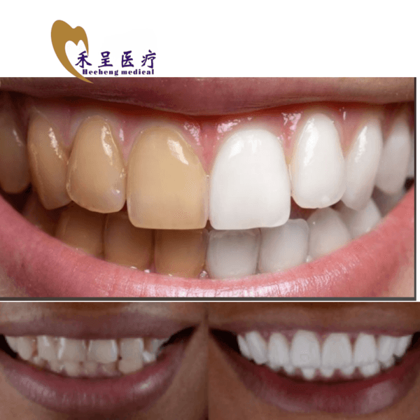 Veneer on Teeth Dental