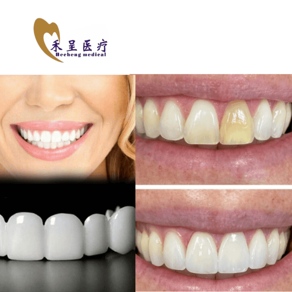 Veneer on Teeth Wholesale