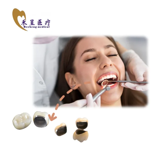 PFM in Dentistry High Quality