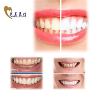 Removable Veneer Teeth High Quality 