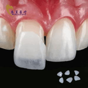 Veneer Tooth Hecheng Manufacturer